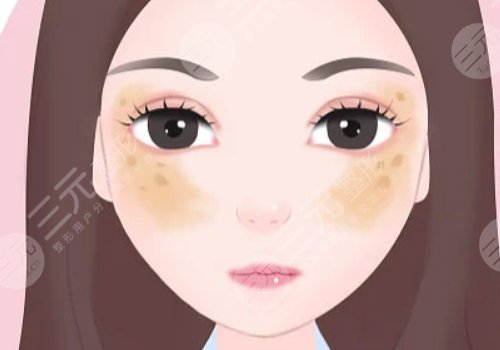 激光祛斑會不會反彈？需要做幾次？