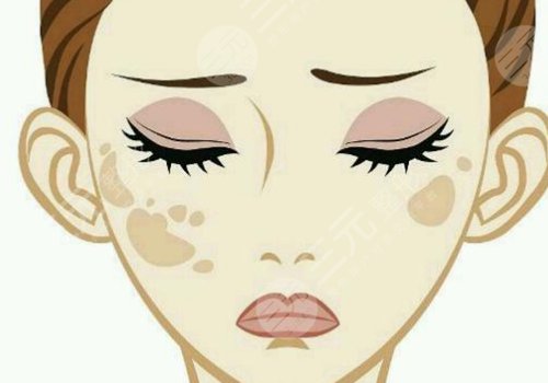 激光祛斑會不會反彈？需要做幾次？