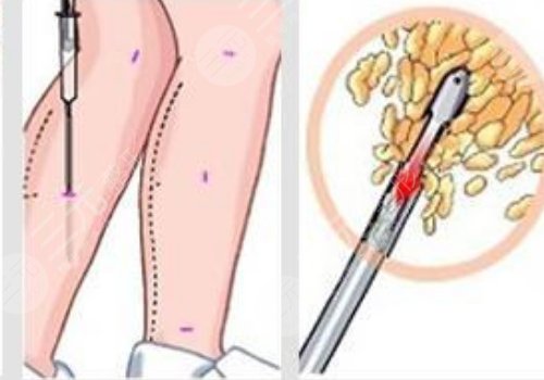 小腿吸脂后多久可以正常走路？