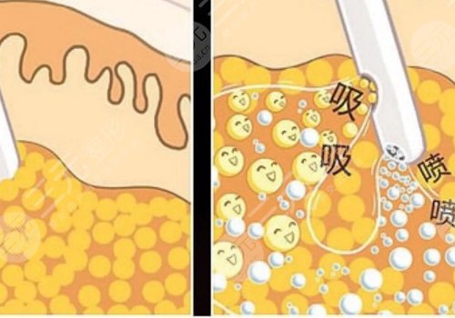 小腿吸脂后多久可以正常走路？