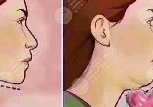 下頜緣輪廓注射多少錢(qián)？能維持多久？