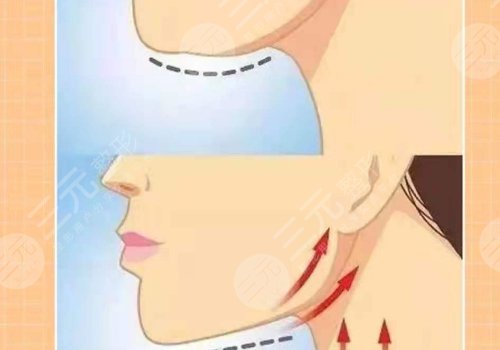 下頜緣輪廓注射多少錢(qián)？能維持多久？