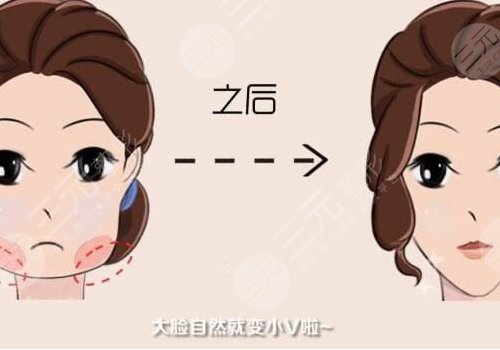 下頜緣輪廓注射多少錢(qián)？能維持多久？