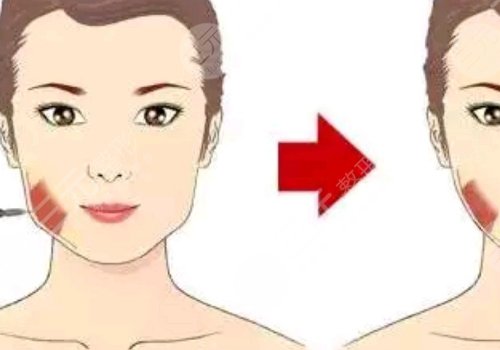 注射瘦臉會(huì)反彈嗎？