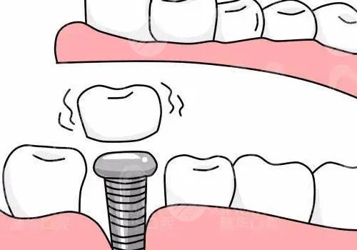 種植牙瑞士瑞典哪個(gè)好？