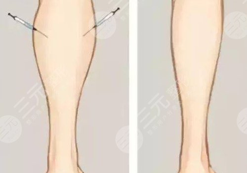 腿部吸脂手術(shù)有什么危害？