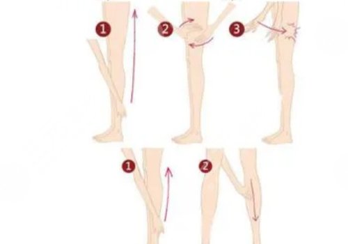 腿部吸脂手術(shù)有什么危害？