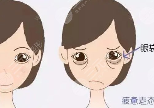 眼袋是怎么產(chǎn)生的？如何消除眼袋？