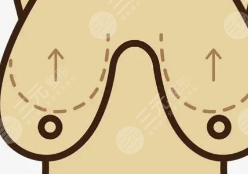 曼托隆胸是什么材質的？多久變軟？