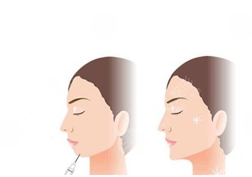 艾莉薇傳奇玻尿酸維持多久？