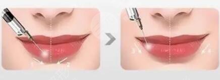 嘴唇整形需要多少錢2023年?