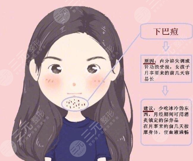 激光祛痘需要多長時間能徹底恢復好？需要緩解幾次？療程是多久？