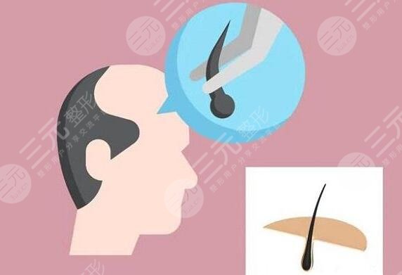 毛發(fā)種植的費(fèi)用是多少2023？?jī)r(jià)格影響根源所在，30秒速覽~