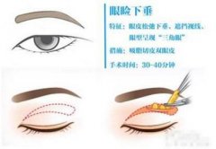 下垂眼瞼緩解方法科普！費(fèi)用多少錢，術(shù)前參考！