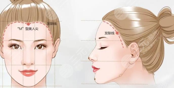 發(fā)際線矯正