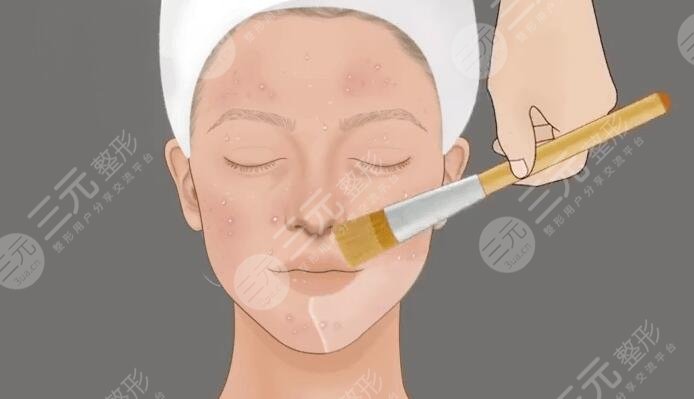 果酸換膚的缺點