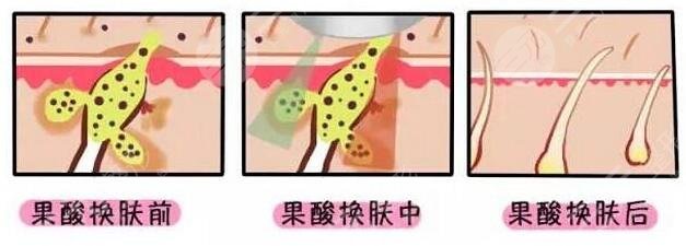果酸換膚的注意事項