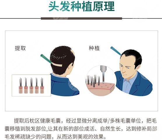 脫發(fā) 植發(fā)