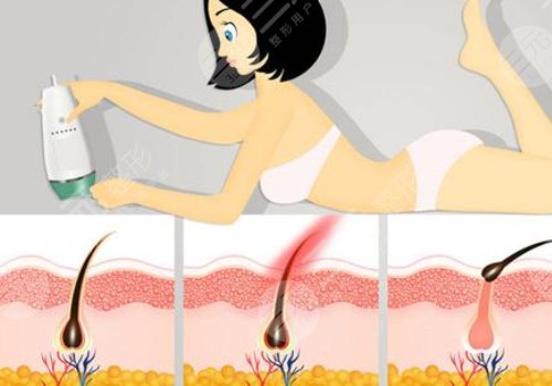 激光脫毛幾次能永久脫毛？