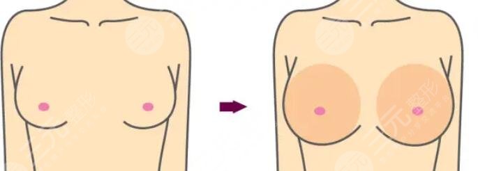 閃耀假體隆胸怎么樣？