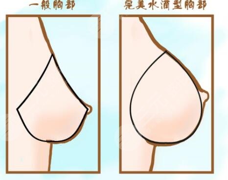 在做完閃耀假體隆胸之后需要注意什么?