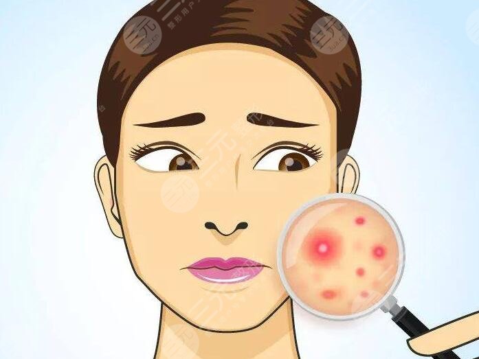緩解青春痘時(shí)需要注意以下幾點(diǎn)：