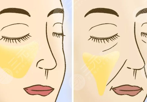 7d聚拉提美容的功效和副作用有哪些？