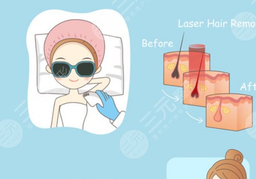 激光脫毛和冰點(diǎn)脫毛有什么區(qū)別？