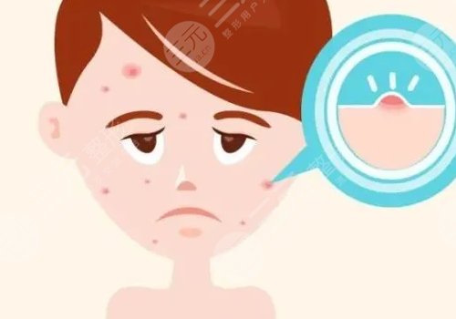 臉上痘坑怎么去除？
