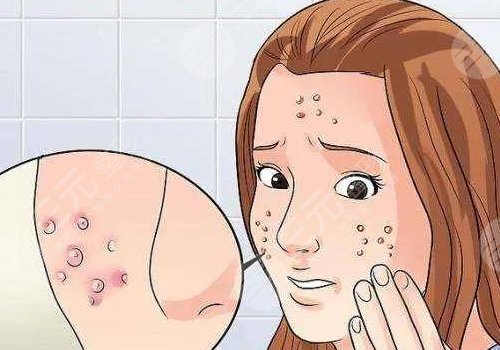 臉上痘坑怎么去除？