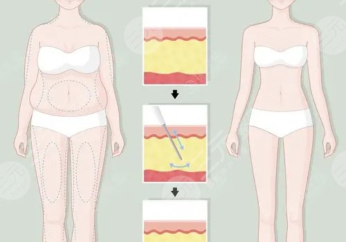 如何減去腹部贅肉？