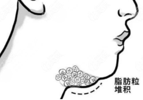 超聲炮下頜緣有必要做嗎？