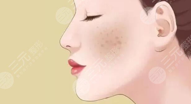 去除黃褐斑價格是多少？怎么預(yù)防和減少黃褐斑的出現(xiàn)？