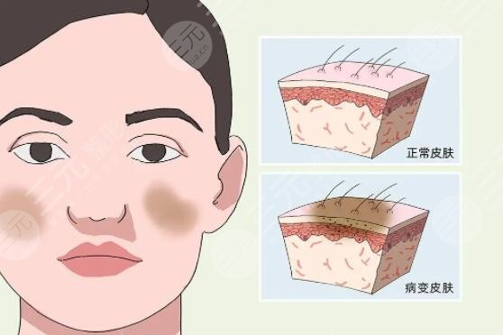 激光去除黃褐斑