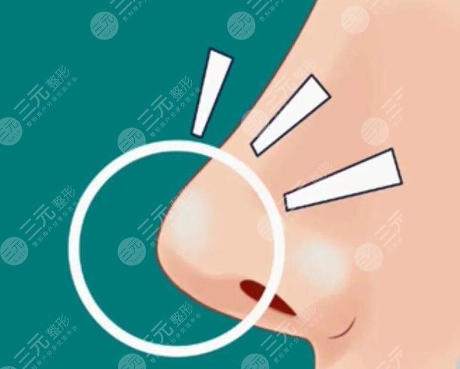 玻尿酸隆鼻有副作用嗎？該怎么避免玻尿酸隆鼻的副作用呢？