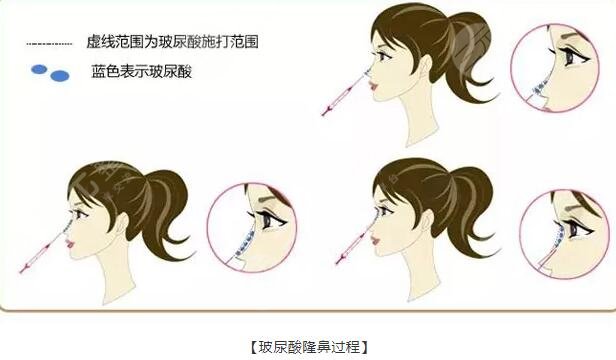 玻尿酸隆鼻的種類及原理