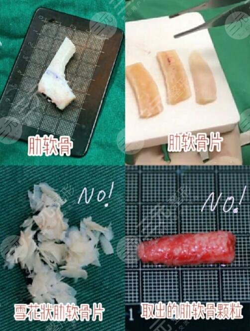 自體軟骨隆鼻的優(yōu)勢