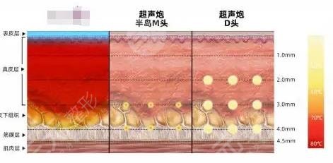 超聲炮下頜緣有必要做嗎？