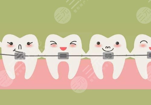 牙套價格一般是多少錢一個