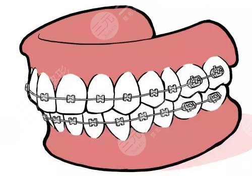 牙套價格一般是多少錢一個