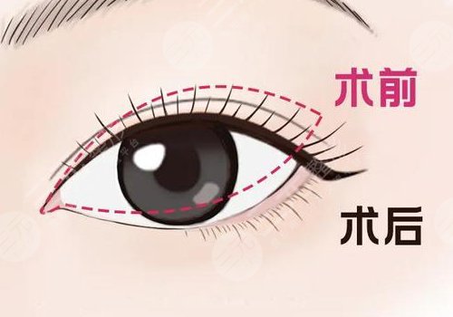 開眼角疼不疼呢？效果如何？