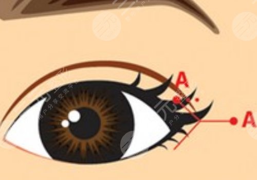 開眼角疼不疼呢？效果如何？