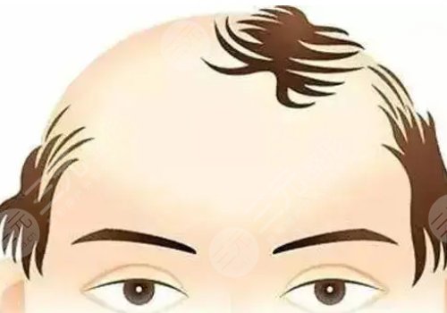 額頭頭發(fā)稀少怎么辦?