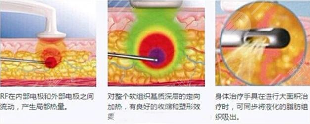 光纖溶脂好不好?