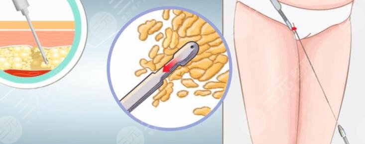 光纖溶脂的優(yōu)缺點(diǎn)