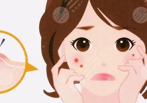 如何去除臉上的青春痘？