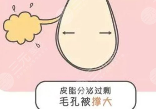 男性毛孔粗大油膩怎么改良？