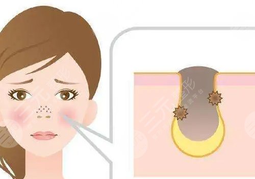 男性毛孔粗大油膩怎么改良？