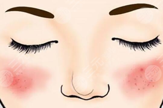 彩光祛紅血絲的危害有哪些？它的原理是什么？注意事項(xiàng)有哪些？