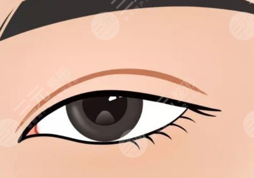 雙眼皮修復(fù)大概多少錢呢？